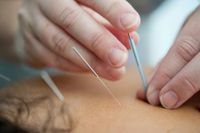 Akupunktur in Mömbris für Rücken- und Knieschmerzen